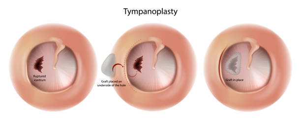 Best Doctor for Tympanoplasty Surgery in Parel